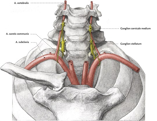 بلاک گانگلیون ستاره ای (stellate ganglion block)